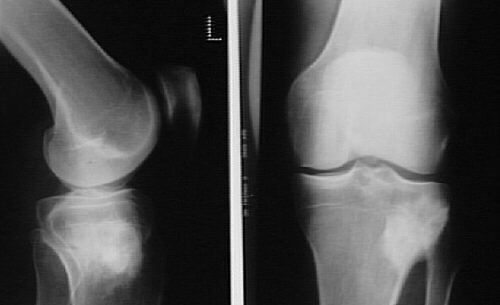 Sarcoma